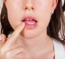 Cancer de buze - simptome, semne timpurii