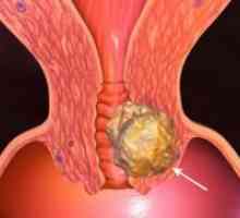 Cancerul de col uterin - cauza