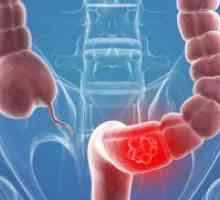 Cancerul de colon sigmoid - primele simptome