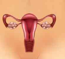 Sklerokistoz ovarian