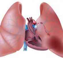 Embolismul pulmonar - simptome, tratament