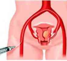 Eliminarea fibrom uterin - Efecte