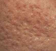Eliminarea cicatrici acnee: selectați programul de tratament individual
