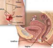Uretrita la femei - Simptome