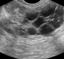 Ultrasunete ovarian