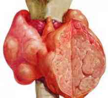 Gusa nodulara a glandei tiroide - simptome și tratament