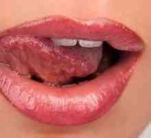 Inflamație a limbii