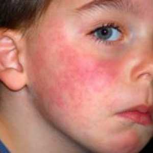 Simptomele de alergii la copii