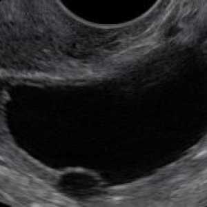 Anehogennoe formarea în ovar