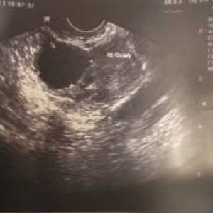 Anehogennoe formarea în uter
