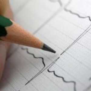 Aritmie cardiaca - cauze si simptome