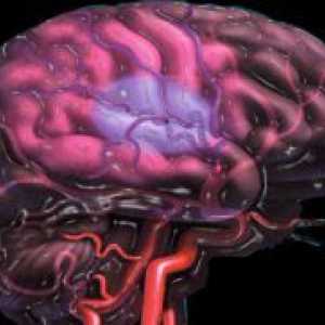 Ateroscleroza cerebral - Simptome