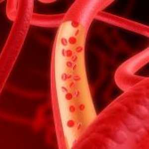 Arterioscleroză