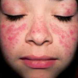 Dermatita atopica - Simptome