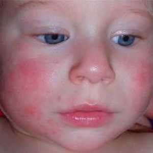 Dermatita atopica la copii - Tratamentul