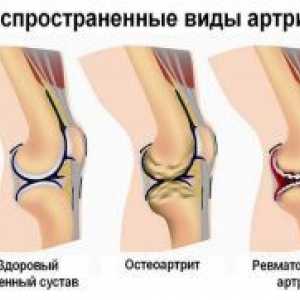 Durere la nivelul articulațiilor picioarelor
