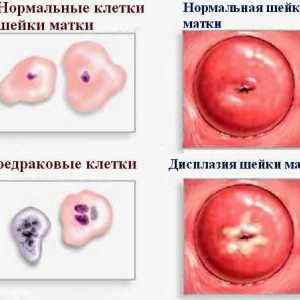 Displazie de col uterin - ce este?