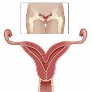 Bicorn uterului si sarcina