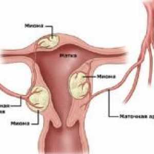 Fibrom uterin