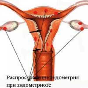 Endometrioza genitale