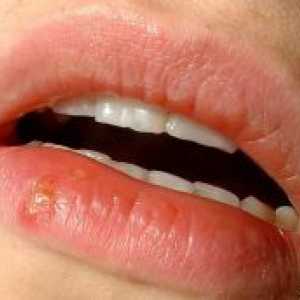 Herpes pe buzele copilului