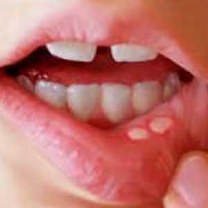 Herpes în gura unui copil
