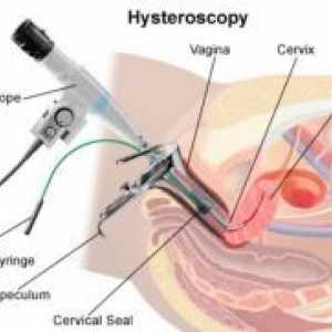 Histeroscopia - consecințele