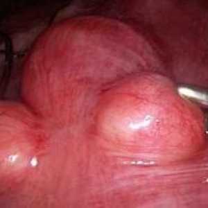 Fibrom uterin subseros interstițiale