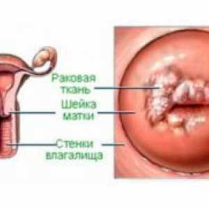 Cancer invaziv de col uterin
