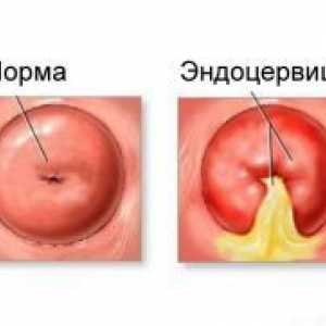 Endotservtsit de col uterin