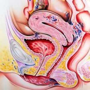 Endometrioza intestinale - Simptome