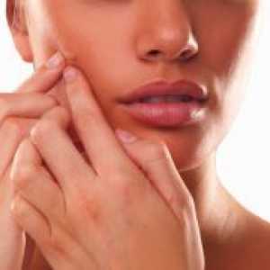 Cum de a elimina cicatrici de acnee?