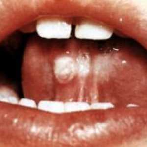 Tusea convulsivă: simptomele la copii