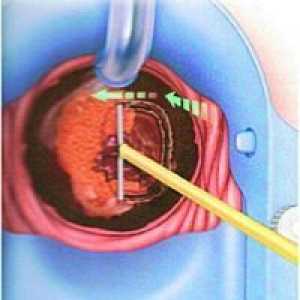 Biopsie con de col uterin - mărturie