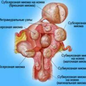 Fibromul uterin - tratament de atac folk