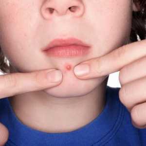Tratamentul de acnee pe bărbie