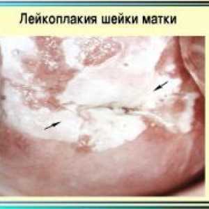Leucoplakia de col uterin - Simptome