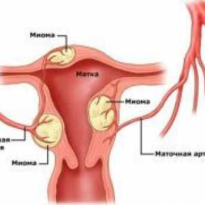 Fibrom uterin si sarcina