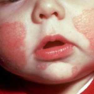 Dermatita atopica la copii
