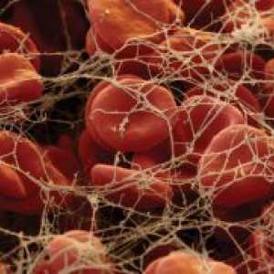 Nivelurile scăzute de trombocite în sânge - motivul