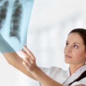 Tuberculoză pulmonară focală