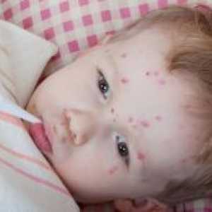 Complicațiile de la varicela la copii