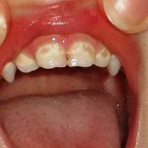 Petele de pe dinții copilului