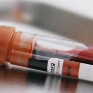 Creșterea de insulină în sânge - Cauze