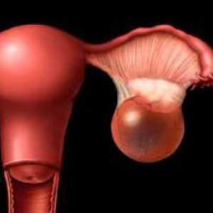Simptomele de chisturi ovariene la femei