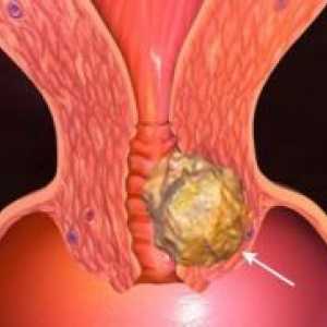 Cancerul de col uterin - cauza