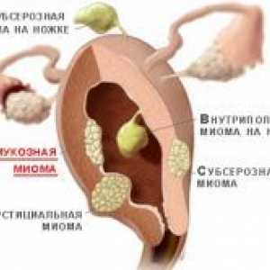 Fibrom uterin submucoasă - tratament