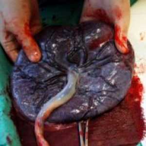Placenta Groasă în timpul sarcinii