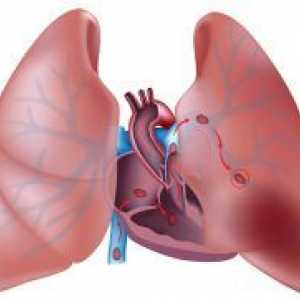 Embolismul pulmonar - simptome, tratament
