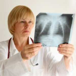 Tuberculoza - Simptome
